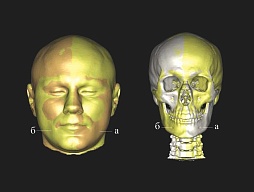 Your Chin as the Basis of Appearance. Face Analysis before the Operation